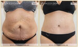 Dr Eddy Dona - Tummy Tucks - O6842 F-min