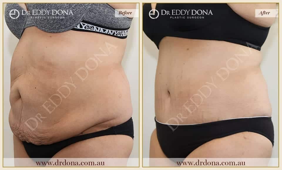 Dr Eddy Dona - Tummy Tucks - O6842 L-min (2)