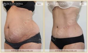 Dr Eddy Dona - Tummy Tuck - Before and After