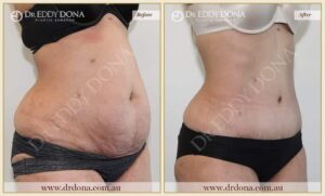 Dr Eddy Dona - Tummy Tuck - Before and After