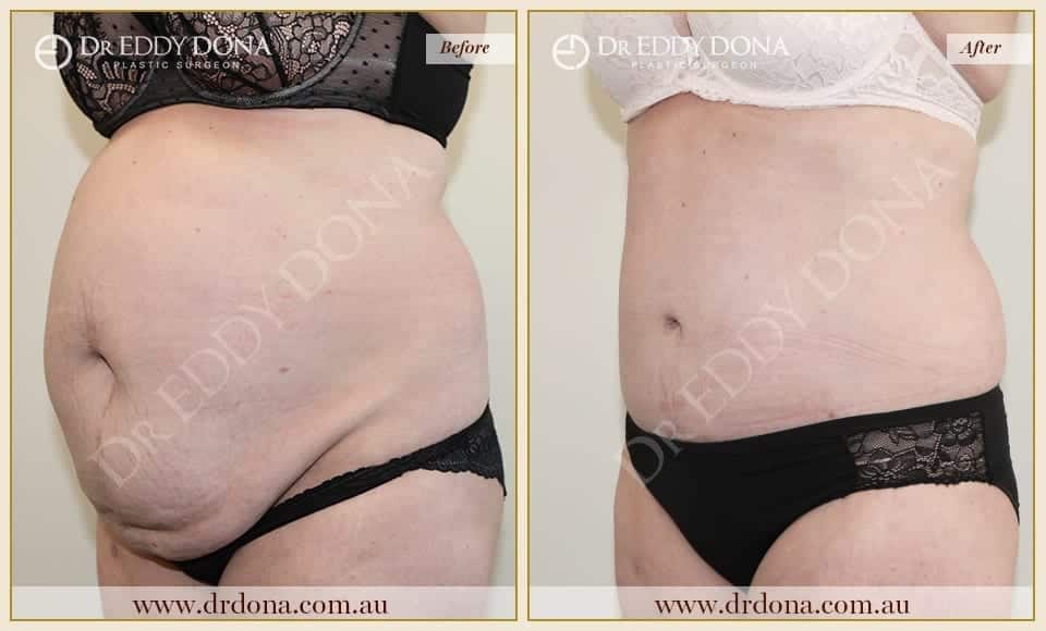 Dr Eddy Dona - Tummy Tuck - Before and After