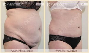 Dr Eddy Dona - Tummy Tuck - Before and After