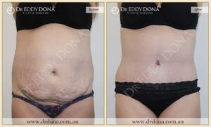 Dr Eddy Dona - Tummy Tuck - Before and After