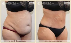 Dr Eddy Dona - Tummy Tuck - Before and After