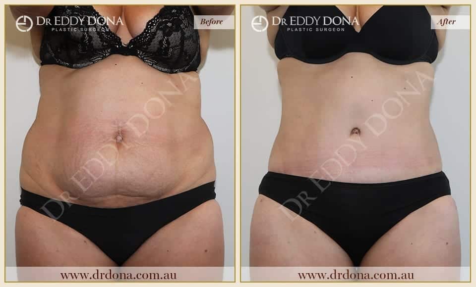 Dr Eddy Dona - Tummy Tuck - Before and After