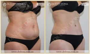 Dr Eddy Dona - Tummy Tuck - Before and After