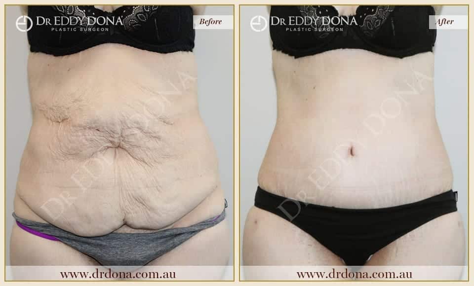 Dr Eddy Dona Tummy Tuck Before and After