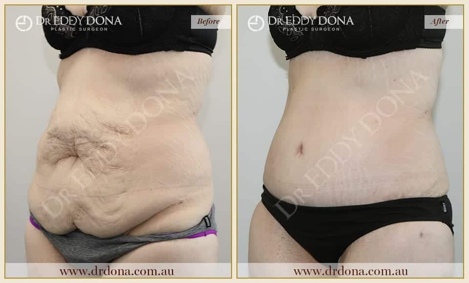 Dr Eddy Dona Tummy Tuck Before and After