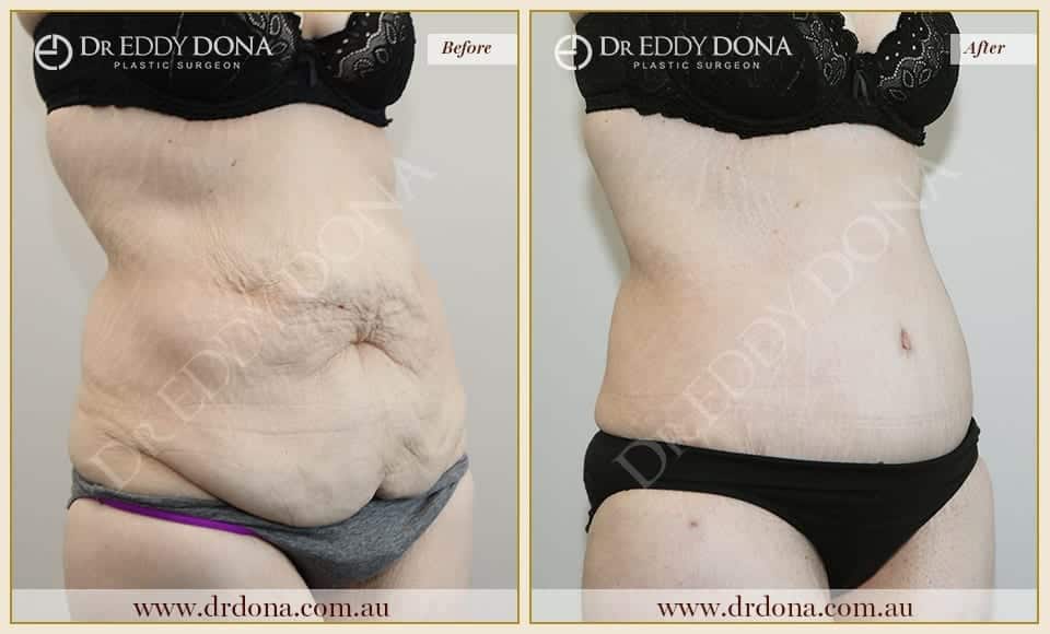 Dr Eddy Dona Tummy Tuck Before and After