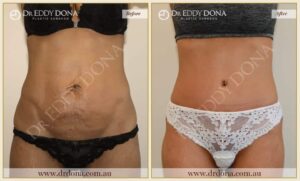 Dr Eddy Dona - Tummy Tuck - Before and After