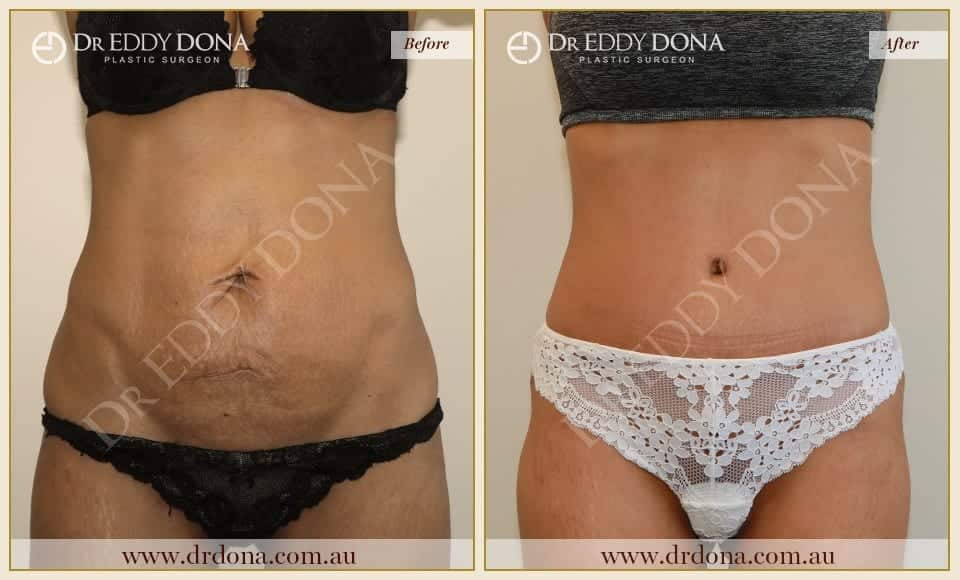 Dr Eddy Dona - Tummy Tuck - Before and After