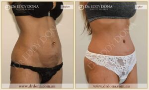 Dr Eddy Dona - Tummy Tuck - Before and After