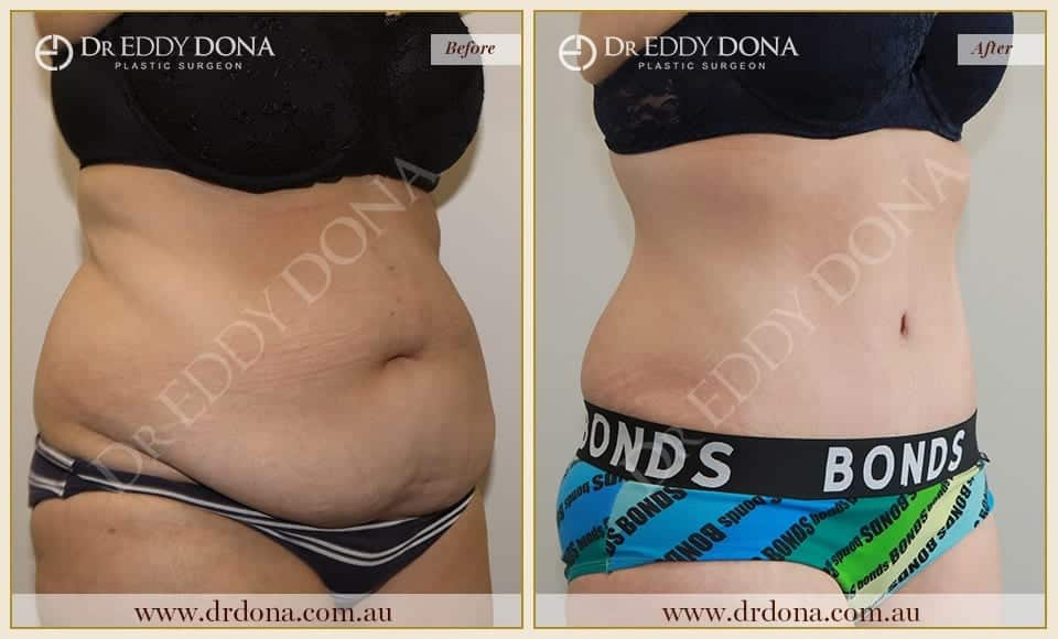 Dr Eddy Dona Tummy Tuck Before and After