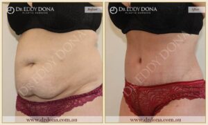 Dr Eddy Dona - Tummy Tuck - Before and After