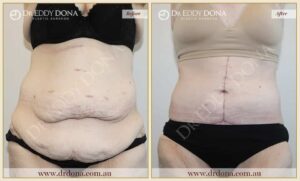 Dr Eddy Dona - Tummy Tuck - Before and After