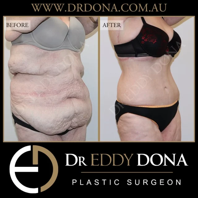 OPEN BOOK TUMMY TUCK ™ (Abdominoplasty)

Dr Dona explains what an Open Book Tummy Tuck is and why some patients would benefit from this Body Contouring Surgical procedure. 
To learn more you can watch this patients surgery on our Snapchat story @DrEddyDona.
 
Experience & Excellence in Plastic Surgery is what you deserve

#DrEddyDona #OpenBook #TummyTuck #Abdominoplasty #PlasticSurgery 

DISCLAIMER: All surgeries on this page are performed by Dr Eddy Dona, and are published with the written consent by the patients. Before & after images are generally shown between 3-6 months post-surgery. 
All surgery carries risks, requires recovery time, and the results will vary for each individual patient. The content on this page is general in nature and is not a substitute for a formal consultation. 
Before proceeding please seek medical advice from an appropriately qualified medical practitioner. 
To learn more visit our website and/or YouTube channel - links can be found in our bio.
Dr Eddy Dona is a Specialist Plastic Surgeon 
(Registration: MED0001177175)