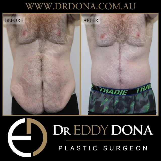 BELT LIPECTOMY (360 Abdominoplasty) with a FLEUR-DE-LIS TUMMY TUCK (Abdominoplasty) 

Experience & Excellence in Plastic Surgery is what you deserve

#DrEddyDona  #PlasticSurgeon #OpenBook  #TummyTuck #Abdominoplasty 

All surgery carries risks. You can learn more by visiting our website - link can be found in our bio. Or go to www.drdonaplasticsurgery.com.au/surgery-risks/ 
DISCLAIMER: All surgeries on this page are performed by Dr Eddy Dona and are published with the written consent by the patients.
After images are generally taken between 3-6 months post-surgery.
All surgery requires recovery time.
The outcomes shown are only relevant for this patient and do not necessarily reflect the results other patients may experience, even if they have a similar body type or shape. Results may vary due to many factors including an individual’s genetics and lifestyle.
The content on this page is general in nature and is not a substitute for a formal consultation. Before proceeding, please seek medical advice from an appropriately qualified medical practitioner. Dr Eddy Dona is a Specialist Plastic Surgeon (Registration: MED0001177175)