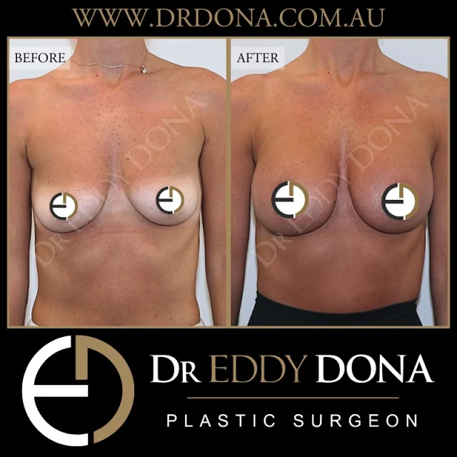 BREAST AUGMENTATION 

Experience & Excellence in Plastic Surgery is what you deserve.

#BreastImplants #DrEddyDona #PlasticSurgery #BreastAugmentation

All surgery carries risks. You can learn more by visiting our website - link can be found in our
bio.
Or go to http://www.drdonaplasticsurgery.com.au/surgery-risks/

DISCLAIMER: All surgeries on this page are performed by Dr Eddy Dona and are published with the written consent by the patients.
After images are generally taken between 3-6 months post-surgery.
All surgery requires recovery time.
The outcomes shown are only relevant for this patient and do not necessarily reflect the results other patients may experience, even if they have a similar body type or shape.
Results may vary due to many factors including an individual’s genetics and lifestyle.
The content on this page is general in nature and is not a substitute for a formal consultation.
Before proceeding, please seek medical advice from an appropriately qualified medical practitioner.
Dr Eddy Dona is a Specialist Plastic Surgeon
(Registration: MED0001177175)