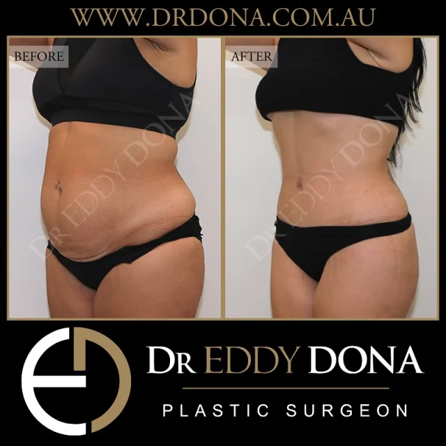 Tummy Tuck (Abdominoplasty)

Experience & Excellence in Plastic Surgery is what you deserve.

#DrEddyDona #PlasticSurgeon #PlasticSurgery #TummyTuck #BreastAugmentation 

All surgery carries risks. You can learn more by visiting our website - link can be found in our bio.
Or go to www.drdonaplasticsurgery.com.au/surgery-risks/
.
DISCLAIMER: All surgeries on this page are performed by Dr Eddy Dona and are published with the written consent by the patients. Before & after images are generally shown between 3-6 months post-surgery.
All surgery requires recovery time.
The outcomes shown are only relevant for this patient and do not necessarily reflect the results other patients may experience, even if they have a similar body type or shape. Results may vary due to many factors including an individual’s genetics and lifestyle.
The content on this page is general in nature and is not a substitute for a formal consultation.
Before proceeding, please seek medical advice from an appropriately qualified medical practitioner.
Dr Eddy Dona is a Specialist Plastic Surgeon
(Registration: MED0001177175)