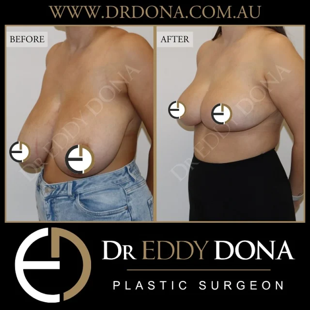 Breast Reduction 

Experience & Excellence in Plastic Surgery is what you deserve.

#DrEddyDona #PlasticSurgeon #PlasticSurgery

All surgery carries risks. You can learn more by visiting our website - link can be found in our bio.
Or go to www.drdonaplasticsurgery.com.au/surgery-risks/
.
DISCLAIMER: All surgeries on this page are performed by Dr Eddy Dona and are published with the written consent by the patients. Before & after images are generally shown between 3-6 months post-surgery.
All surgery requires recovery time.
The outcomes shown are only relevant for this patient and do not necessarily reflect the results other patients may experience, even if they have a similar body type or shape. Results may vary due to many factors including an individual’s genetics and lifestyle.
The content on this page is general in nature and is not a substitute for a formal consultation.
Before proceeding, please seek medical advice from an appropriately qualified medical practitioner.
Dr Eddy Dona is a Specialist Plastic Surgeon
(Registration: MED0001177175)