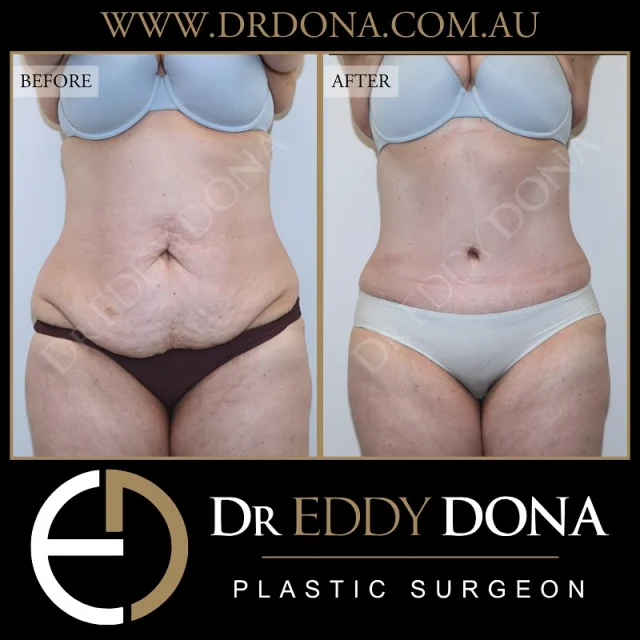 Tummy Tuck (Abdominoplasty)

Experience & Excellence in Plastic Surgery is what you deserve.

#DrEddyDona #PlasticSurgeon #PlasticSurgery #TummyTuck #BreastAugmentation 

All surgery carries risks. You can learn more by visiting our website - link can be found in our bio.
Or go to www.drdonaplasticsurgery.com.au/surgery-risks/
.
DISCLAIMER: All surgeries on this page are performed by Dr Eddy Dona and are published with the written consent by the patients. Before & after images are generally shown between 3-6 months post-surgery.
All surgery requires recovery time.
The outcomes shown are only relevant for this patient and do not necessarily reflect the results other patients may experience, even if they have a similar body type or shape. Results may vary due to many factors including an individual’s genetics and lifestyle.
The content on this page is general in nature and is not a substitute for a formal consultation.
Before proceeding, please seek medical advice from an appropriately qualified medical practitioner.
Dr Eddy Dona is a Specialist Plastic Surgeon
(Registration: MED0001177175)