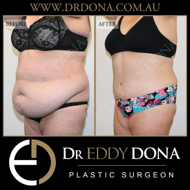 TUMMY TUCK (Abdominoplasty)

Experience & Excellence in Plastic Surgery is what you deserve

#DrEddyDona #TummyTuck #Abdominoplasty

DISCLAIMER: All surgeries on this page are performed by Dr Eddy Dona, and are published with the written consent by the patients. Before & after images are generally shown between 3-6 months post-surgery. 
All surgery carries risks, requires recovery time, and the results will vary for each individual patient. The content on this page is general in nature and is not a substitute for a formal consultation. 
Before proceeding please seek medical advice from an appropriately qualified medical practitioner. 
To learn more visit our website and/or YouTube channel - links can be found in our bio.
Dr Eddy Dona is a Specialist Plastic Surgeon 
(Registration: MED0001177175)