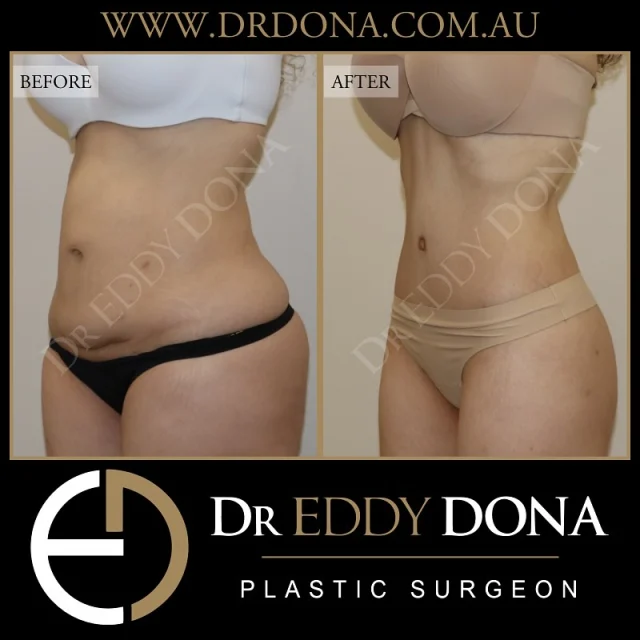 360 Tummy Tuck (Abdominoplasty) 

This patient was reviewed approximately 6 months post surgery. 

The 360 Tummy Tuck is an operation that goes by many different names:

- Belt Lipectomy
- Lower Body Lift 
- Total Body Lift
- Lower Truncoplasty 
- Buttock Lift combined with a Tummy Tuck

Experience & Excellence in Plastic Surgery is what you deserve

#DrEddyDona  #PlasticSurgeon #BraLipectomy  #FleurDeLis #OpenBook  #TummyTuck#Abdominoplasty #BeltLipectomy 

All surgery carries risks. You can learn more by visiting our website - link can be found in our bio. Or go to www.drdonaplasticsurgery.com.au/surgery-risks/ 
DISCLAIMER: All surgeries on this page are performed by Dr Eddy Dona and are published with the written consent by the patients.
After images are generally taken between 3-6 months post-surgery.
All surgery requires recovery time.
The outcomes shown are only relevant for this patient and do not necessarily reflect the results other patients may experience, even if they have a similar body type or shape. Results may vary due to many factors including an individual’s genetics and lifestyle.
The content on this page is general in nature and is not a substitute for a formal consultation. Before proceeding, please seek medical advice from an appropriately qualified medical practitioner. Dr Eddy Dona is a Specialist Plastic Surgeon (Registration: MED0001177175)