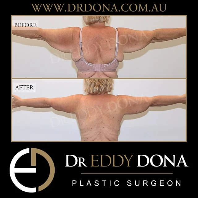 ARM REDUCTION (Brachioplasty) 

Experience & Excellence in Plastic Surgery is what you deserve

#DrEddyDona  #PlasticSurgeon #OpenBook  #TummyTuck #Abdominoplasty 

All surgery carries risks. You can learn more by visiting our website - link can be found in our bio. Or go to www.drdonaplasticsurgery.com.au/surgery-risks/ 
DISCLAIMER: All surgeries on this page are performed by Dr Eddy Dona and are published with the written consent by the patients.
After images are generally taken between 3-6 months post-surgery.
All surgery requires recovery time.
The outcomes shown are only relevant for this patient and do not necessarily reflect the results other patients may experience, even if they have a similar body type or shape. Results may vary due to many factors including an individual’s genetics and lifestyle.
The content on this page is general in nature and is not a substitute for a formal consultation. Before proceeding, please seek medical advice from an appropriately qualified medical practitioner. Dr Eddy Dona is a Specialist Plastic Surgeon (Registration: MED0001177175)