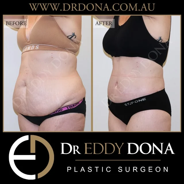 BELT LIPECTOMY (Total Body Lift) 

Experience & Excellence in Plastic Surgery is what you deserve

#DrEddyDona #OpenBook #TotalBodyLift#Abdominoplasty #PlasticSurgery 

DISCLAIMER: All surgeries on this page are performed by Dr Eddy Dona, and are published with the written consent by the patients. Before & after images are generally shown between 3-6 months post-surgery. 
All surgery carries risks, requires recovery time, and the results will vary for each individual patient. The content on this page is general in nature and is not a substitute for a formal consultation. 
Before proceeding please seek medical advice from an appropriately qualified medical practitioner. 
To learn more visit our website and/or YouTube channel - links can be found in our bio.
Dr Eddy Dona is a Specialist Plastic Surgeon 
(Registration: MED0001177175)