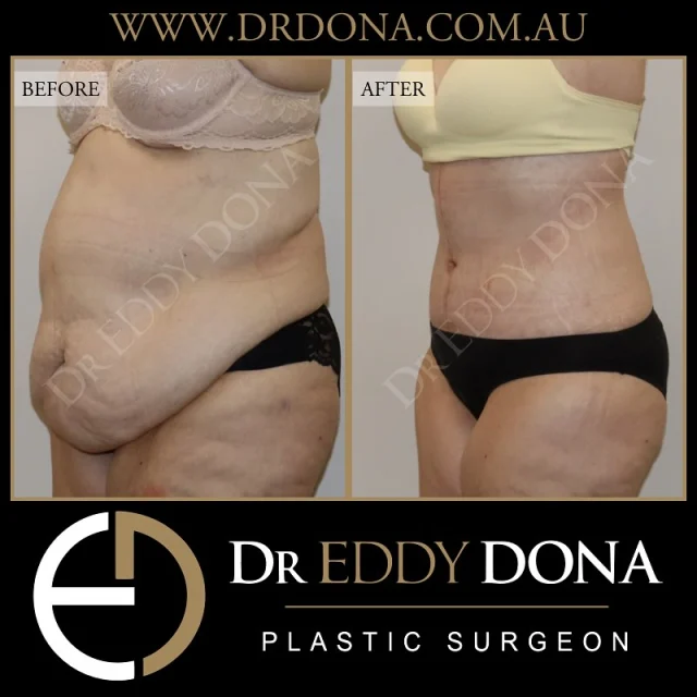 OPEN BOOK TUMMY TUCK ™ (Abdominoplasty)
& BRA LIPECTOMY

This patient was seen approximately 6 weeks post surgery. 

Patients that are having an Open Book Tummy Tuck often require a Bra Lipectomy to optimise the results. 
 
Experience & Excellence in Plastic Surgery is what you deserve

#DrEddyDona #OpenBook #TummyTuck #Abdominoplasty #PlasticSurgery 

DISCLAIMER: All surgeries on this page are performed by Dr Eddy Dona, and are published with the written consent by the patients. Before & after images are generally shown between 3-6 months post-surgery. 
All surgery carries risks, requires recovery time, and the results will vary for each individual patient. The content on this page is general in nature and is not a substitute for a formal consultation. 
Before proceeding please seek medical advice from an appropriately qualified medical practitioner. 
To learn more visit our website and/or YouTube channel - links can be found in our bio.
Dr Eddy Dona is a Specialist Plastic Surgeon 
(Registration: MED0001177175)