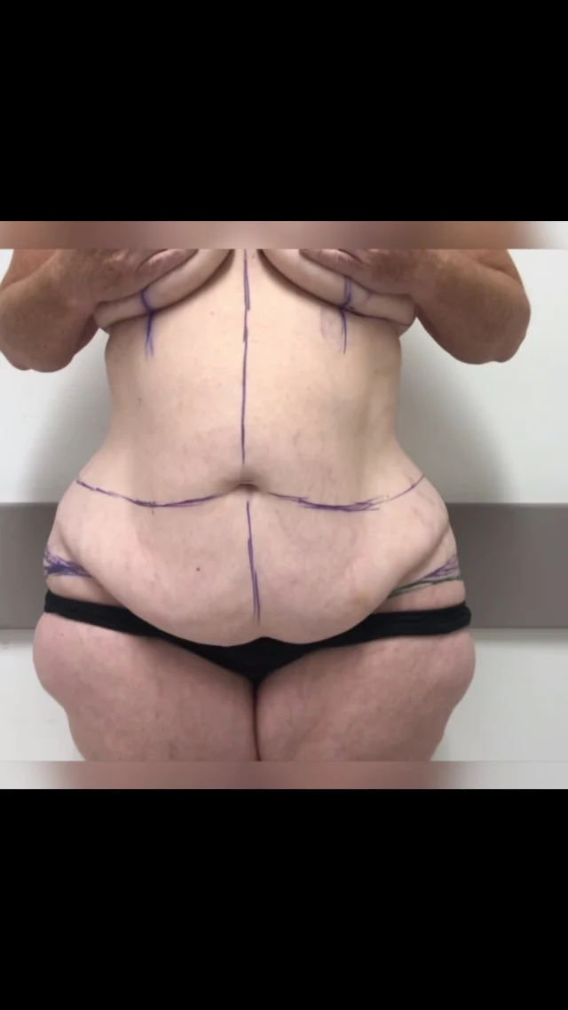 BELT LIPECTOMY

This patient was reviewed approximately 6 weeks post surgery. She also had a Breast Reduction. 

The Belt Lipectomy is an operation that goes by many different names:

- 360 Tummy Tuck (Abdominoplasty)
- Lower Body Lift 
- Total Body Lift
- Lower Truncoplasty 
- Buttock Lift combined with a Tummy Tuck

Experience & Excellence in Plastic Surgery is what you deserve

#DrEddyDona  #PlasticSurgeon #BraLipectomy  #FleurDeLis #OpenBook  #TummyTuck#Abdominoplasty #BeltLipectomy 

All surgery carries risks. You can learn more by visiting our website - link can be found in our bio. Or go to www.drdonaplasticsurgery.com.au/surgery-risks/ 
DISCLAIMER: All surgeries on this page are performed by Dr Eddy Dona and are published with the written consent by the patients.
After images are generally taken between 3-6 months post-surgery.
All surgery requires recovery time.
The outcomes shown are only relevant for this patient and do not necessarily reflect the results other patients may experience, even if they have a similar body type or shape. Results may vary due to many factors including an individual’s genetics and lifestyle.
The content on this page is general in nature and is not a substitute for a formal consultation. Before proceeding, please seek medical advice from an appropriately qualified medical practitioner. Dr Eddy Dona is a Specialist Plastic Surgeon (Registration: MED0001177175)