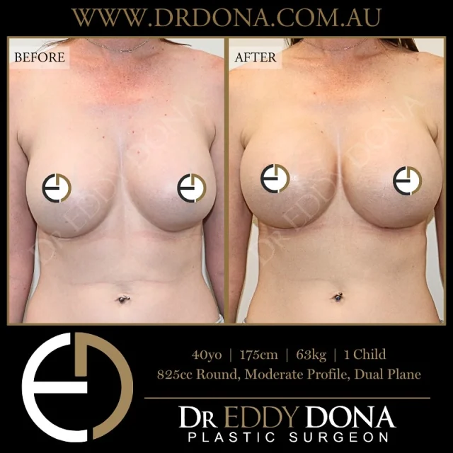 BREAST IMPLANT EXCHANGE 

Experience & Excellence in Plastic Surgery is what you deserve.

#BreastImplants #DrEddyDona #PlasticSurgery #BreastAugmentation

All surgery carries risks. You can learn more by visiting our website - link can be found in our
bio.
Or go to http://www.drdonaplasticsurgery.com.au/surgery-risks/

DISCLAIMER: All surgeries on this page are performed by Dr Eddy Dona and are published with the written consent by the patients.
After images are generally taken between 3-6 months post-surgery.
All surgery requires recovery time.
The outcomes shown are only relevant for this patient and do not necessarily reflect the results other patients may experience, even if they have a similar body type or shape.
Results may vary due to many factors including an individual’s genetics and lifestyle.
The content on this page is general in nature and is not a substitute for a formal consultation.
Before proceeding, please seek medical advice from an appropriately qualified medical practitioner.
Dr Eddy Dona is a Specialist Plastic Surgeon
(Registration: MED0001177175)