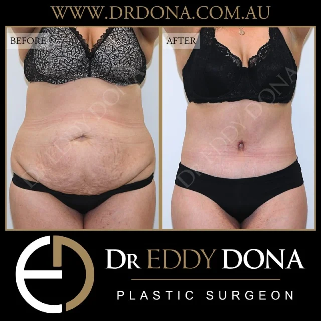 BELT LIPECTOMY (Total Body Lift) 

Experience & Excellence in Plastic Surgery is what you deserve

#DrEddyDona #OpenBook #TotalBodyLift#Abdominoplasty #PlasticSurgery 

DISCLAIMER: All surgeries on this page are performed by Dr Eddy Dona, and are published with the written consent by the patients. Before & after images are generally shown between 3-6 months post-surgery. 
All surgery carries risks, requires recovery time, and the results will vary for each individual patient. The content on this page is general in nature and is not a substitute for a formal consultation. 
Before proceeding please seek medical advice from an appropriately qualified medical practitioner. 
To learn more visit our website and/or YouTube channel - links can be found in our bio.
Dr Eddy Dona is a Specialist Plastic Surgeon 
(Registration: MED0001177175)