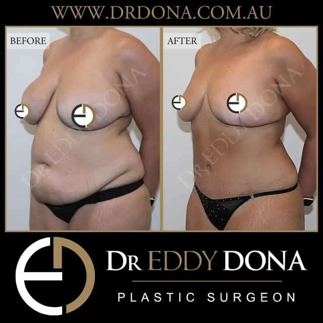 REMOVAL OF BREAST IMPLANTS + BREAST LIFT (Mastopexy) & TUMMY TUCK (Abdominoplasty) 

Experience & Excellence in Plastic Surgery is what you deserve.

#BreastImplants #DrEddyDona #PlasticSurgery #BreastAugmentation

All surgery carries risks. You can learn more by visiting our website - link can be found in our
bio.
Or go to http://www.drdonaplasticsurgery.com.au/surgery-risks/

DISCLAIMER: All surgeries on this page are performed by Dr Eddy Dona and are published with the written consent by the patients.
After images are generally taken between 3-6 months post-surgery.
All surgery requires recovery time.
The outcomes shown are only relevant for this patient and do not necessarily reflect the results other patients may experience, even if they have a similar body type or shape.
Results may vary due to many factors including an individual’s genetics and lifestyle.
The content on this page is general in nature and is not a substitute for a formal consultation.
Before proceeding, please seek medical advice from an appropriately qualified medical practitioner.
Dr Eddy Dona is a Specialist Plastic Surgeon
(Registration: MED0001177175)