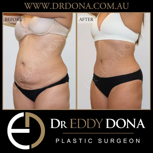 Tummy Tuck (Abdominoplasty)

Experience & Excellence in Plastic Surgery is what you deserve.

#DrEddyDona #PlasticSurgeon #PlasticSurgery #TummyTuck #BreastAugmentation 

All surgery carries risks. You can learn more by visiting our website - link can be found in our bio.
Or go to www.drdonaplasticsurgery.com.au/surgery-risks/
.
DISCLAIMER: All surgeries on this page are performed by Dr Eddy Dona and are published with the written consent by the patients. Before & after images are generally shown between 3-6 months post-surgery.
All surgery requires recovery time.
The outcomes shown are only relevant for this patient and do not necessarily reflect the results other patients may experience, even if they have a similar body type or shape. Results may vary due to many factors including an individual’s genetics and lifestyle.
The content on this page is general in nature and is not a substitute for a formal consultation.
Before proceeding, please seek medical advice from an appropriately qualified medical practitioner.
Dr Eddy Dona is a Specialist Plastic Surgeon
(Registration: MED0001177175)