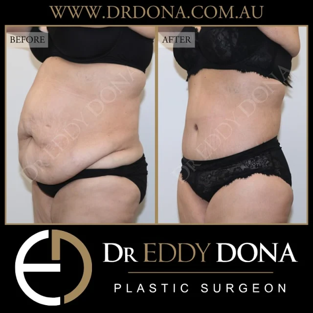 360 Tummy Tuck (Abdominoplasty)

Experience & Excellence in Plastic Surgery is what you deserve.

#DrEddyDona #PlasticSurgeon #PlasticSurgery #TummyTuck #BreastAugmentation 

All surgery carries risks. You can learn more by visiting our website - link can be found in our bio.
Or go to www.drdonaplasticsurgery.com.au/surgery-risks/
.
DISCLAIMER: All surgeries on this page are performed by Dr Eddy Dona and are published with the written consent by the patients. Before & after images are generally shown between 3-6 months post-surgery.
All surgery requires recovery time.
The outcomes shown are only relevant for this patient and do not necessarily reflect the results other patients may experience, even if they have a similar body type or shape. Results may vary due to many factors including an individual’s genetics and lifestyle.
The content on this page is general in nature and is not a substitute for a formal consultation.
Before proceeding, please seek medical advice from an appropriately qualified medical practitioner.
Dr Eddy Dona is a Specialist Plastic Surgeon
(Registration: MED0001177175)