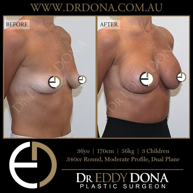 BREAST AUGMENTATION 

Experience & Excellence in Plastic Surgery is what you deserve.

#BreastImplants #DrEddyDona #PlasticSurgery #BreastAugmentation

All surgery carries risks. You can learn more by visiting our website - link can be found in our
bio.
Or go to http://www.drdonaplasticsurgery.com.au/surgery-risks/

DISCLAIMER: All surgeries on this page are performed by Dr Eddy Dona and are published with the written consent by the patients.
After images are generally taken between 3-6 months post-surgery.
All surgery requires recovery time.
The outcomes shown are only relevant for this patient and do not necessarily reflect the results other patients may experience, even if they have a similar body type or shape.
Results may vary due to many factors including an individual’s genetics and lifestyle.
The content on this page is general in nature and is not a substitute for a formal consultation.
Before proceeding, please seek medical advice from an appropriately qualified medical practitioner.
Dr Eddy Dona is a Specialist Plastic Surgeon
(Registration: MED0001177175)