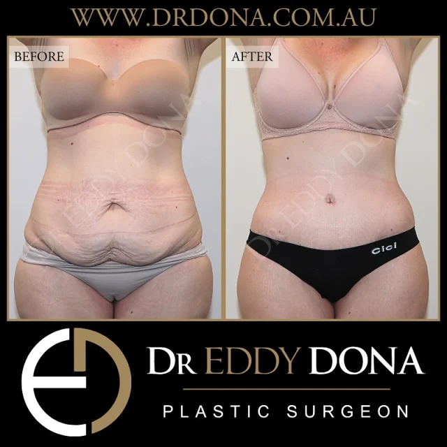 Tummy Tuck (Abdominoplasty)

Experience & Excellence in Plastic Surgery is what you deserve.

#DrEddyDona #PlasticSurgeon #PlasticSurgery #TummyTuck #BreastAugmentation 

All surgery carries risks. You can learn more by visiting our website - link can be found in our bio.
Or go to www.drdonaplasticsurgery.com.au/surgery-risks/
.
DISCLAIMER: All surgeries on this page are performed by Dr Eddy Dona and are published with the written consent by the patients. Before & after images are generally shown between 3-6 months post-surgery.
All surgery requires recovery time.
The outcomes shown are only relevant for this patient and do not necessarily reflect the results other patients may experience, even if they have a similar body type or shape. Results may vary due to many factors including an individual’s genetics and lifestyle.
The content on this page is general in nature and is not a substitute for a formal consultation.
Before proceeding, please seek medical advice from an appropriately qualified medical practitioner.
Dr Eddy Dona is a Specialist Plastic Surgeon
(Registration: MED0001177175)