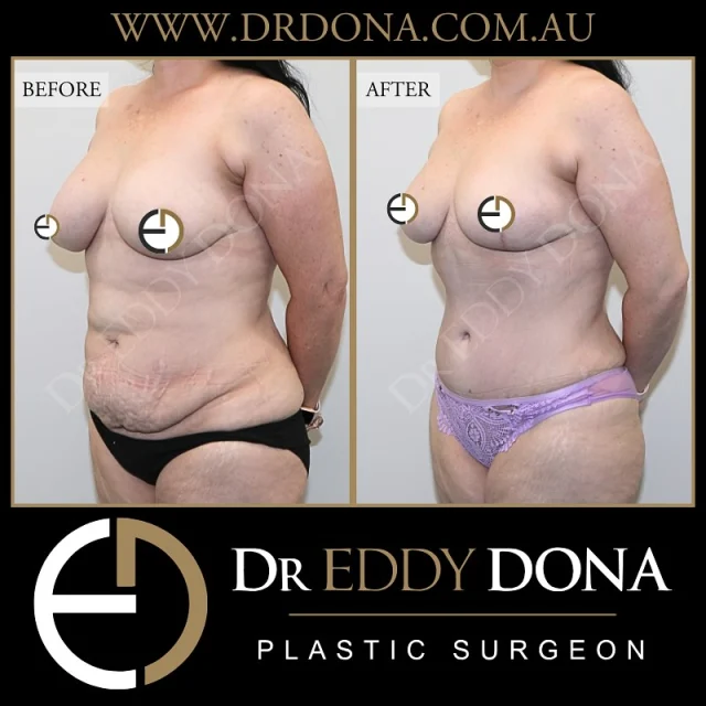 BREAST REDUCTION & TUMMY TUCK (Abdominoplasty) 

Experience & Excellence in Plastic Surgery is what you deserve.

#BreastImplants #DrEddyDona #PlasticSurgery #BreastAugmentation

All surgery carries risks. You can learn more by visiting our website - link can be found in our
bio.
Or go to http://www.drdonaplasticsurgery.com.au/surgery-risks/

DISCLAIMER: All surgeries on this page are performed by Dr Eddy Dona and are published with the written consent by the patients.
After images are generally taken between 3-6 months post-surgery.
All surgery requires recovery time.
The outcomes shown are only relevant for this patient and do not necessarily reflect the results other patients may experience, even if they have a similar body type or shape.
Results may vary due to many factors including an individual’s genetics and lifestyle.
The content on this page is general in nature and is not a substitute for a formal consultation.
Before proceeding, please seek medical advice from an appropriately qualified medical practitioner.
Dr Eddy Dona is a Specialist Plastic Surgeon
(Registration: MED0001177175)