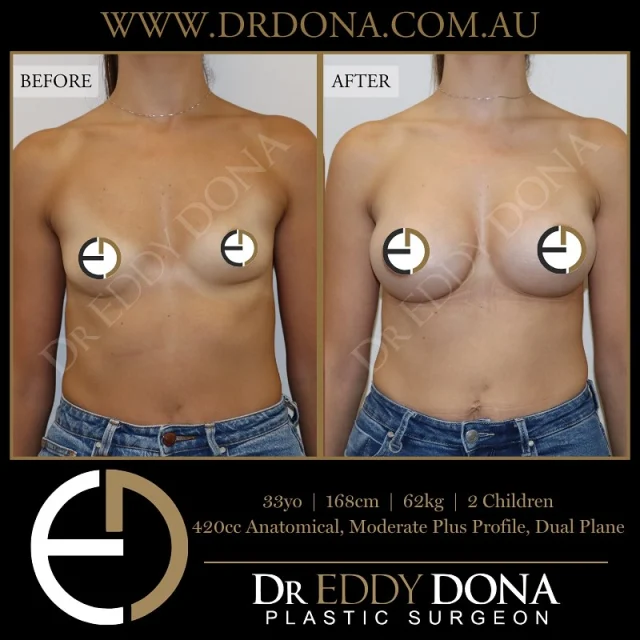 BREAST AUGMENTATION 

Experience & Excellence in Plastic Surgery is what you deserve.

#BreastImplants #DrEddyDona #PlasticSurgery #BreastAugmentation

All surgery carries risks. You can learn more by visiting our website - link can be found in our
bio.
Or go to http://www.drdonaplasticsurgery.com.au/surgery-risks/

DISCLAIMER: All surgeries on this page are performed by Dr Eddy Dona and are published with the written consent by the patients.
After images are generally taken between 3-6 months post-surgery.
All surgery requires recovery time.
The outcomes shown are only relevant for this patient and do not necessarily reflect the results other patients may experience, even if they have a similar body type or shape.
Results may vary due to many factors including an individual’s genetics and lifestyle.
The content on this page is general in nature and is not a substitute for a formal consultation.
Before proceeding, please seek medical advice from an appropriately qualified medical practitioner.
Dr Eddy Dona is a Specialist Plastic Surgeon
(Registration: MED0001177175)