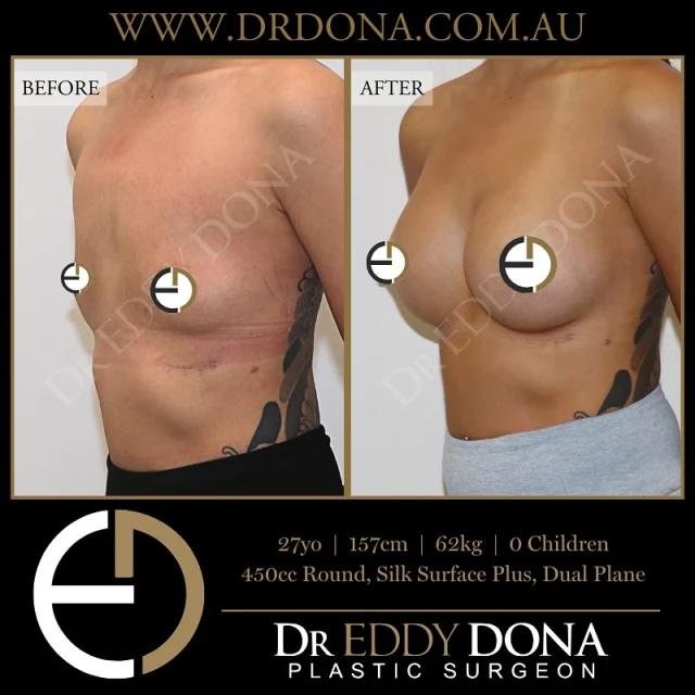 BREAST AUGMENTATION 

Experience & Excellence in Plastic Surgery is what you deserve.

#BreastImplants #DrEddyDona #PlasticSurgery #BreastAugmentation

All surgery carries risks. You can learn more by visiting our website - link can be found in our
bio.
Or go to http://www.drdonaplasticsurgery.com.au/surgery-risks/

DISCLAIMER: All surgeries on this page are performed by Dr Eddy Dona and are published with the written consent by the patients.
After images are generally taken between 3-6 months post-surgery.
All surgery requires recovery time.
The outcomes shown are only relevant for this patient and do not necessarily reflect the results other patients may experience, even if they have a similar body type or shape.
Results may vary due to many factors including an individual’s genetics and lifestyle.
The content on this page is general in nature and is not a substitute for a formal consultation.
Before proceeding, please seek medical advice from an appropriately qualified medical practitioner.
Dr Eddy Dona is a Specialist Plastic Surgeon
(Registration: MED0001177175)