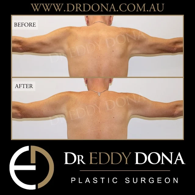 ARM REDUCTION (Brachioplasty) 

Experience & Excellence in Plastic Surgery is what you deserve

#DrEddyDona  #PlasticSurgeon #OpenBook  #TummyTuck #Abdominoplasty 

All surgery carries risks. You can learn more by visiting our website - link can be found in our bio. Or go to www.drdonaplasticsurgery.com.au/surgery-risks/ 
DISCLAIMER: All surgeries on this page are performed by Dr Eddy Dona and are published with the written consent by the patients.
After images are generally taken between 3-6 months post-surgery.
All surgery requires recovery time.
The outcomes shown are only relevant for this patient and do not necessarily reflect the results other patients may experience, even if they have a similar body type or shape. Results may vary due to many factors including an individual’s genetics and lifestyle.
The content on this page is general in nature and is not a substitute for a formal consultation. Before proceeding, please seek medical advice from an appropriately qualified medical practitioner. Dr Eddy Dona is a Specialist Plastic Surgeon (Registration: MED0001177175)