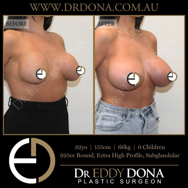 BREAST IMPLANT EXCHANGE 

Experience & Excellence in Plastic Surgery is what you deserve.

#BreastImplants #DrEddyDona #PlasticSurgery #BreastAugmentation

All surgery carries risks. You can learn more by visiting our website - link can be found in our
bio.
Or go to http://www.drdonaplasticsurgery.com.au/surgery-risks/

DISCLAIMER: All surgeries on this page are performed by Dr Eddy Dona and are published with the written consent by the patients.
After images are generally taken between 3-6 months post-surgery.
All surgery requires recovery time.
The outcomes shown are only relevant for this patient and do not necessarily reflect the results other patients may experience, even if they have a similar body type or shape.
Results may vary due to many factors including an individual’s genetics and lifestyle.
The content on this page is general in nature and is not a substitute for a formal consultation.
Before proceeding, please seek medical advice from an appropriately qualified medical practitioner.
Dr Eddy Dona is a Specialist Plastic Surgeon
(Registration: MED0001177175)