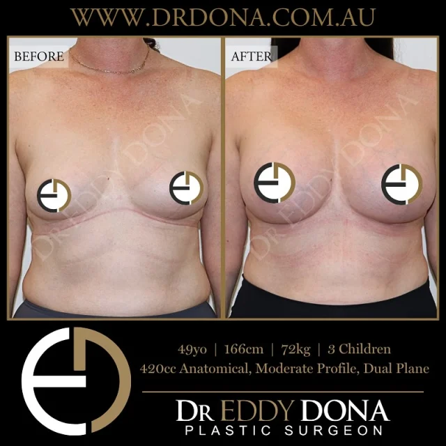 BREAST AUGMENTATION 

Experience & Excellence in Plastic Surgery is what you deserve.

#BreastImplants #DrEddyDona #PlasticSurgery #BreastAugmentation

All surgery carries risks. You can learn more by visiting our website - link can be found in our
bio.
Or go to http://www.drdonaplasticsurgery.com.au/surgery-risks/

DISCLAIMER: All surgeries on this page are performed by Dr Eddy Dona and are published with the written consent by the patients.
After images are generally taken between 3-6 months post-surgery.
All surgery requires recovery time.
The outcomes shown are only relevant for this patient and do not necessarily reflect the results other patients may experience, even if they have a similar body type or shape.
Results may vary due to many factors including an individual’s genetics and lifestyle.
The content on this page is general in nature and is not a substitute for a formal consultation.
Before proceeding, please seek medical advice from an appropriately qualified medical practitioner.
Dr Eddy Dona is a Specialist Plastic Surgeon
(Registration: MED0001177175)