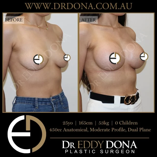 BREAST AUGMENTATION 

Experience & Excellence in Plastic Surgery is what you deserve.

#BreastImplants #DrEddyDona #PlasticSurgery #BreastAugmentation

All surgery carries risks. You can learn more by visiting our website - link can be found in our
bio.
Or go to http://www.drdonaplasticsurgery.com.au/surgery-risks/

DISCLAIMER: All surgeries on this page are performed by Dr Eddy Dona and are published with the written consent by the patients.
After images are generally taken between 3-6 months post-surgery.
All surgery requires recovery time.
The outcomes shown are only relevant for this patient and do not necessarily reflect the results other patients may experience, even if they have a similar body type or shape.
Results may vary due to many factors including an individual’s genetics and lifestyle.
The content on this page is general in nature and is not a substitute for a formal consultation.
Before proceeding, please seek medical advice from an appropriately qualified medical practitioner.
Dr Eddy Dona is a Specialist Plastic Surgeon
(Registration: MED0001177175)