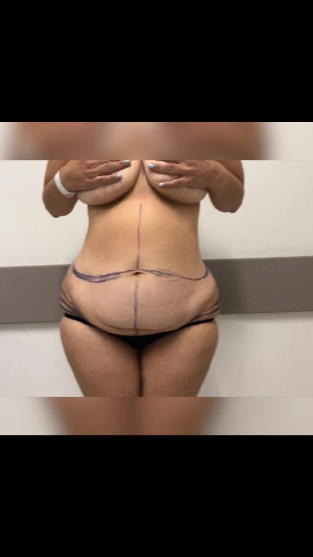 BELT LIPECTOMY

The Belt Lipectomy is an operation that goes by many different names:

- 360 Tummy Tuck (Abdominoplasty)
- Lower Body Lift 
- Total Body Lift
- Lower Truncoplasty 
- Buttock Lift combined with a Tummy Tuck

Experience & Excellence in Plastic Surgery is what you deserve

#DrEddyDona  #PlasticSurgeon #BraLipectomy  #FleurDeLis #OpenBook  #TummyTuck#Abdominoplasty #BeltLipectomy 

All surgery carries risks. You can learn more by visiting our website - link can be found in our bio. Or go to www.drdonaplasticsurgery.com.au/surgery-risks/ 
DISCLAIMER: All surgeries on this page are performed by Dr Eddy Dona and are published with the written consent by the patients.
After images are generally taken between 3-6 months post-surgery.
All surgery requires recovery time.
The outcomes shown are only relevant for this patient and do not necessarily reflect the results other patients may experience, even if they have a similar body type or shape. Results may vary due to many factors including an individual’s genetics and lifestyle.
The content on this page is general in nature and is not a substitute for a formal consultation. Before proceeding, please seek medical advice from an appropriately qualified medical practitioner. Dr Eddy Dona is a Specialist Plastic Surgeon (Registration: MED0001177175)