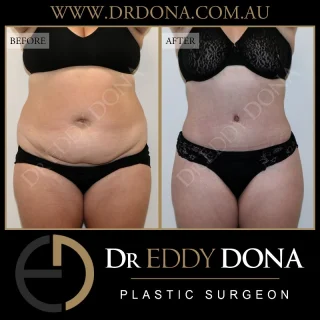 ABDOMINOPLASTY (TUMMY TUCK)

Experience & Excellence in Plastic Surgery is what you deserve

#DrEddyDona #TummyTuck #Abdominoplasty

DISCLAIMER: All surgeries on this page are performed by Dr Eddy Dona, and are published with the written consent by the patients. Before & after images are generally shown between 3-6 months post-surgery. 
All surgery carries risks, requires recovery time, and the results will vary for each individual patient. The content on this page is general in nature and is not a substitute for a formal consultation. 
Before proceeding please seek medical advice from an appropriately qualified medical practitioner. 
To learn more visit our website and/or YouTube channel - links can be found in our bio.
Dr Eddy Dona is a Specialist Plastic Surgeon 
(Registration: MED0001177175)