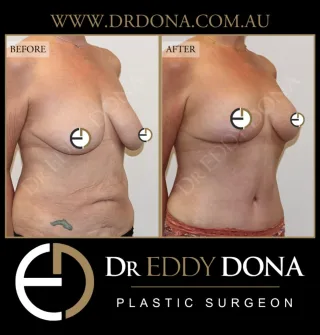 BREAST LIFT (Mastopexy) & TUMMY TUCK (Abdominoplasty) 

Experience & Excellence in Plastic Surgery is what you deserve.

#BreastImplants #DrEddyDona #PlasticSurgery #BreastAugmentation

All surgery carries risks. You can learn more by visiting our website - link can be found in our
bio.
Or go to http://www.drdonaplasticsurgery.com.au/surgery-risks/

DISCLAIMER: All surgeries on this page are performed by Dr Eddy Dona and are published with the written consent by the patients.
After images are generally taken between 3-6 months post-surgery.
All surgery requires recovery time.
The outcomes shown are only relevant for this patient and do not necessarily reflect the results other patients may experience, even if they have a similar body type or shape.
Results may vary due to many factors including an individual’s genetics and lifestyle.
The content on this page is general in nature and is not a substitute for a formal consultation.
Before proceeding, please seek medical advice from an appropriately qualified medical practitioner.
Dr Eddy Dona is a Specialist Plastic Surgeon
(Registration: MED0001177175)