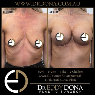 BIO Lift ™: Breast Implant Only Lift 

Experience & Excellence in Plastic Surgery is what you deserve.

#BreastImplants #DrEddyDona #PlasticSurgery #BreastAugmentation

All surgery carries risks. You can learn more by visiting our website - link can be found in our
bio.
Or go to http://www.drdonaplasticsurgery.com.au/surgery-risks/

DISCLAIMER: All surgeries on this page are performed by Dr Eddy Dona and are published with the written consent by the patients.
After images are generally taken between 3-6 months post-surgery.
All surgery requires recovery time.
The outcomes shown are only relevant for this patient and do not necessarily reflect the results other patients may experience, even if they have a similar body type or shape.
Results may vary due to many factors including an individual’s genetics and lifestyle.
The content on this page is general in nature and is not a substitute for a formal consultation.
Before proceeding, please seek medical advice from an appropriately qualified medical practitioner.
Dr Eddy Dona is a Specialist Plastic Surgeon
(Registration: MED0001177175)