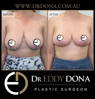 BREAST REDUCTION 

Experience & Excellence in Plastic Surgery is what you deserve.

#BreastImplants #DrEddyDona #PlasticSurgery #BreastReduction 

All surgery carries risks. You can learn more by visiting our website - link can be found in our
bio.
Or go to http://www.drdonaplasticsurgery.com.au/surgery-risks/

DISCLAIMER: All surgeries on this page are performed by Dr Eddy Dona and are published with the written consent by the patients.
After images are generally taken between 3-6 months post-surgery.
All surgery requires recovery time.
The outcomes shown are only relevant for this patient and do not necessarily reflect the results other patients may experience, even if they have a similar body type or shape.
Results may vary due to many factors including an individual’s genetics and lifestyle.
The content on this page is general in nature and is not a substitute for a formal consultation.
Before proceeding, please seek medical advice from an appropriately qualified medical practitioner.
Dr Eddy Dona is a Specialist Plastic Surgeon
(Registration: MED0001177175)